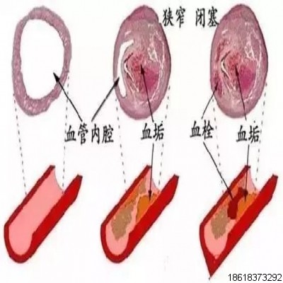 玉林中醫(yī)院開展三氧大自血療法